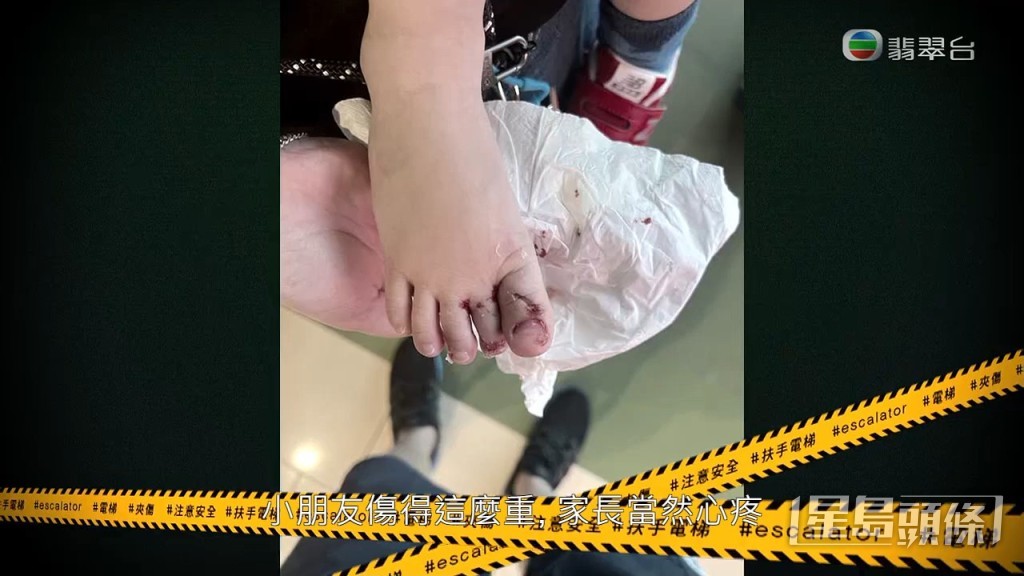 三隻腳趾傷勢亦非常嚴重。
