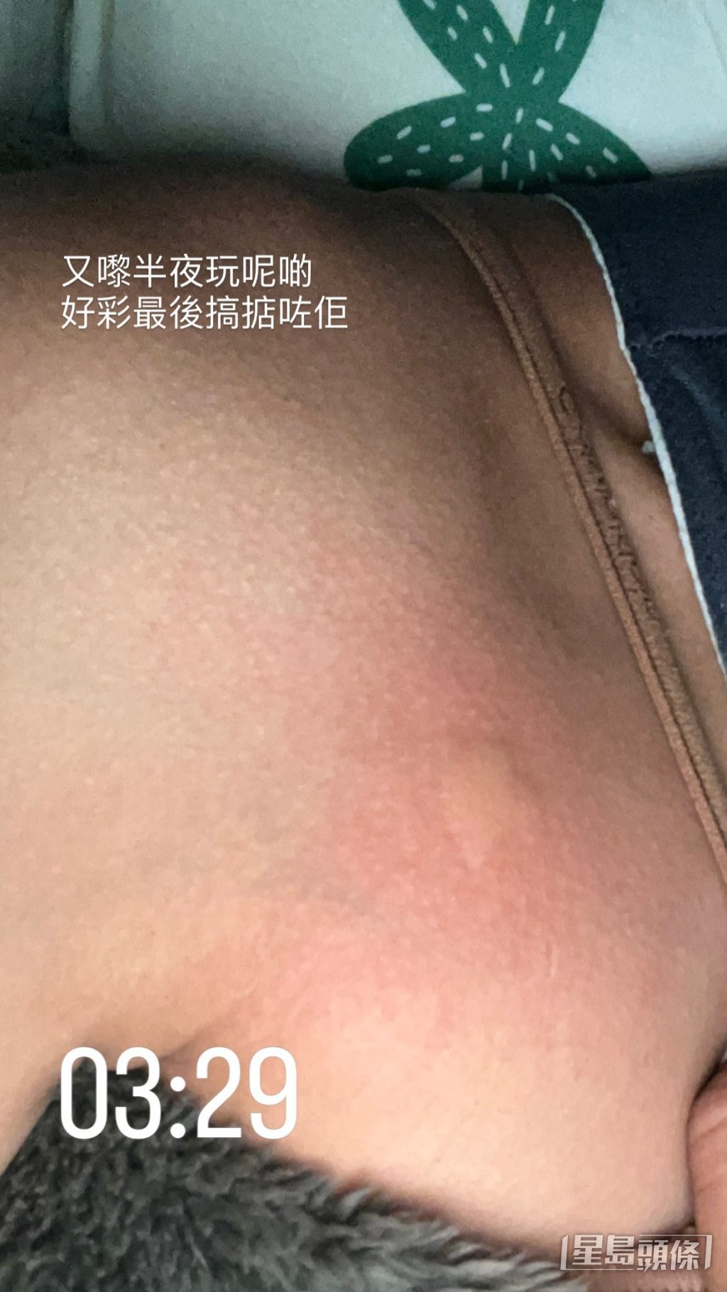梁諾妍在限時動態出PO,表示半夜被蚊針。