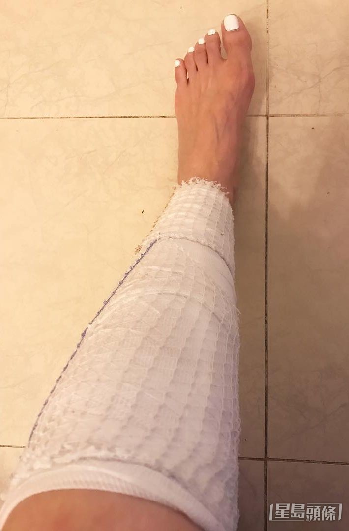 劉佩玥曾經整傷腳。