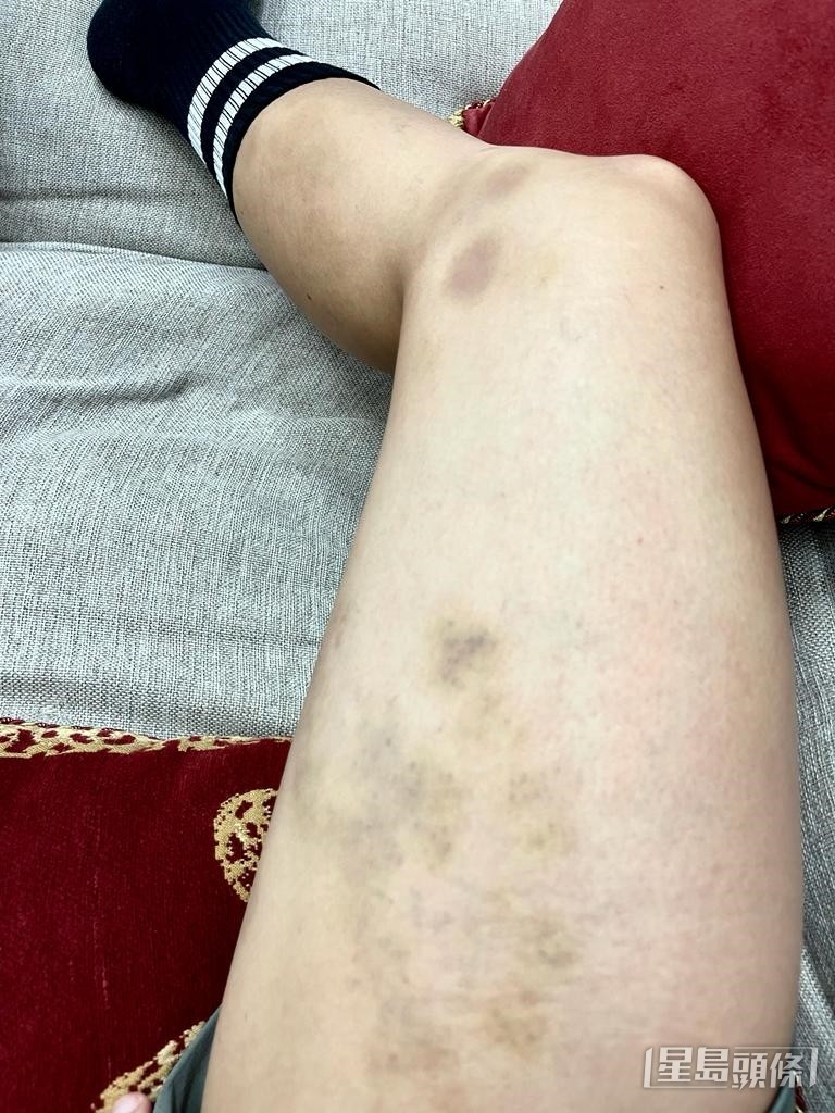 練習時撞到對腳瘀晒。
