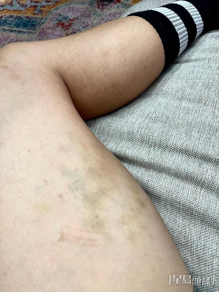 練習時撞到對腳瘀晒。