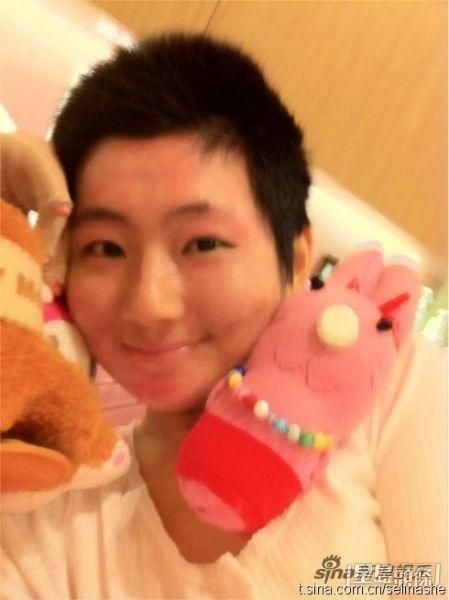 Selina嚴重破相,其手部、腿部及背部等多處均被火吻。