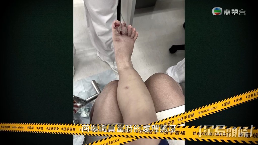 三隻腳趾傷勢亦非常嚴重。