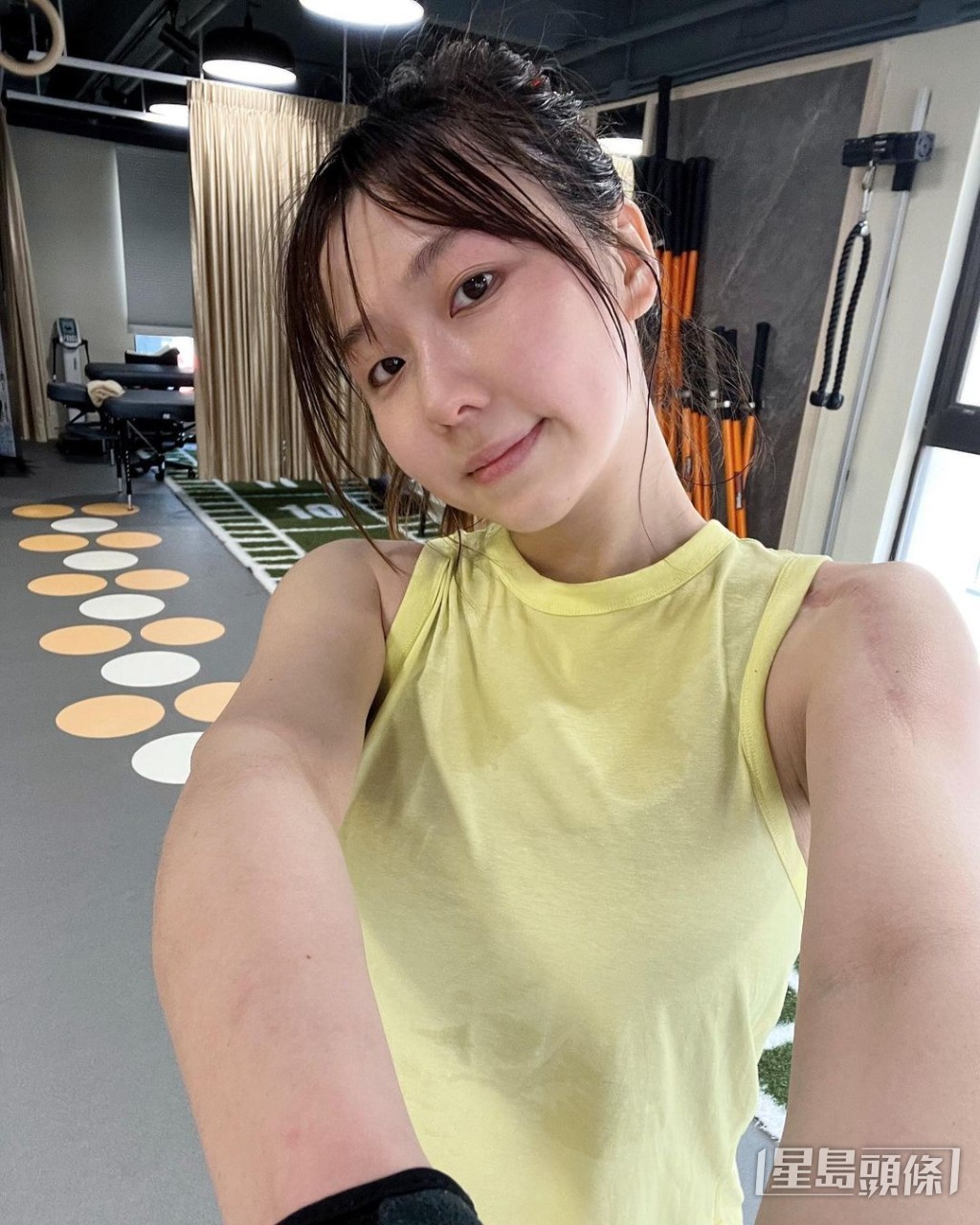左肩動手術後的疤痕仍清晰可見，但對她絕對沒有影響。