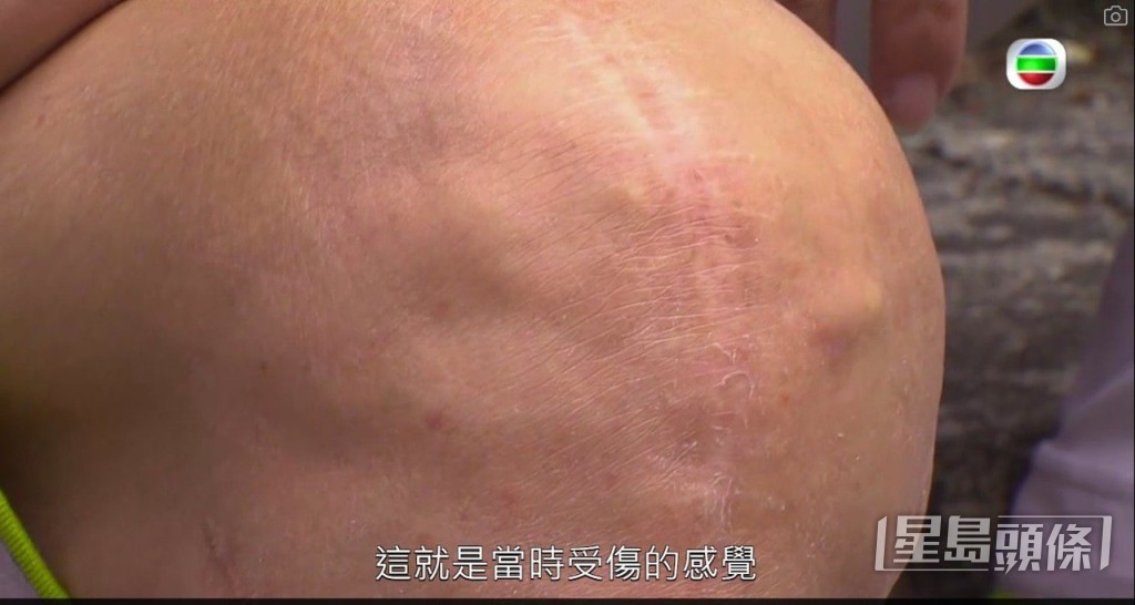 徐忠信曾經展示過自己的傷勢。