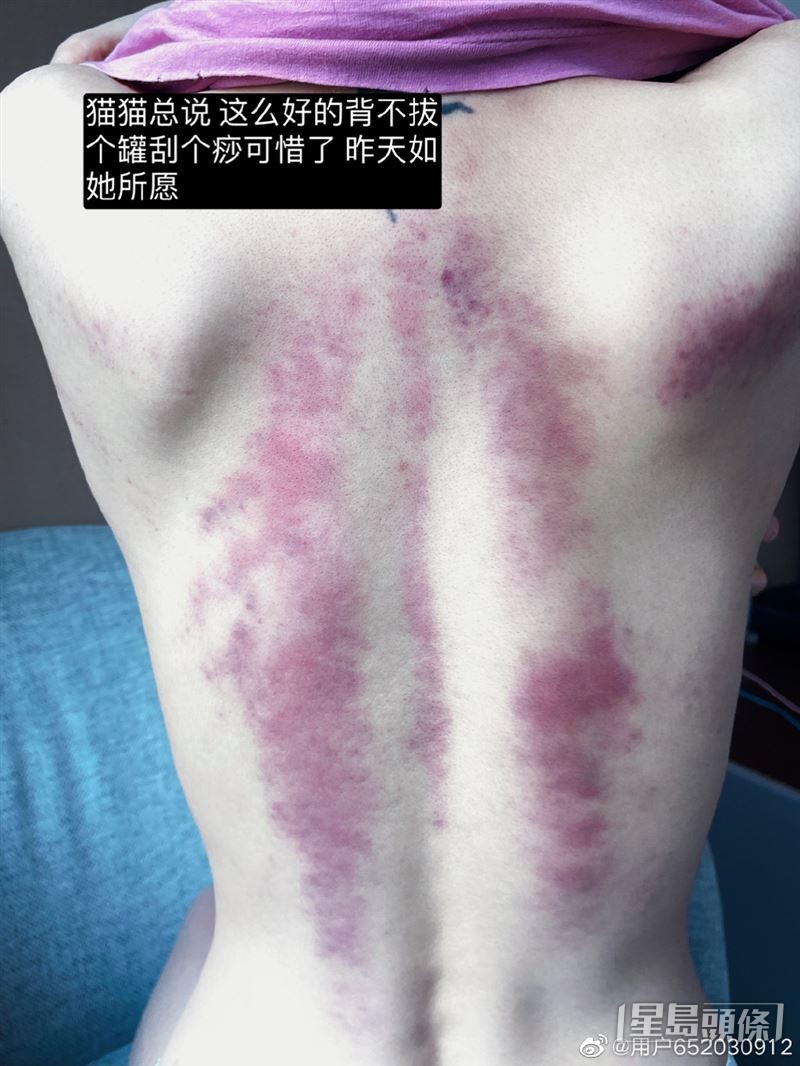 周扬青晒裸背公开刮痧的痕迹。