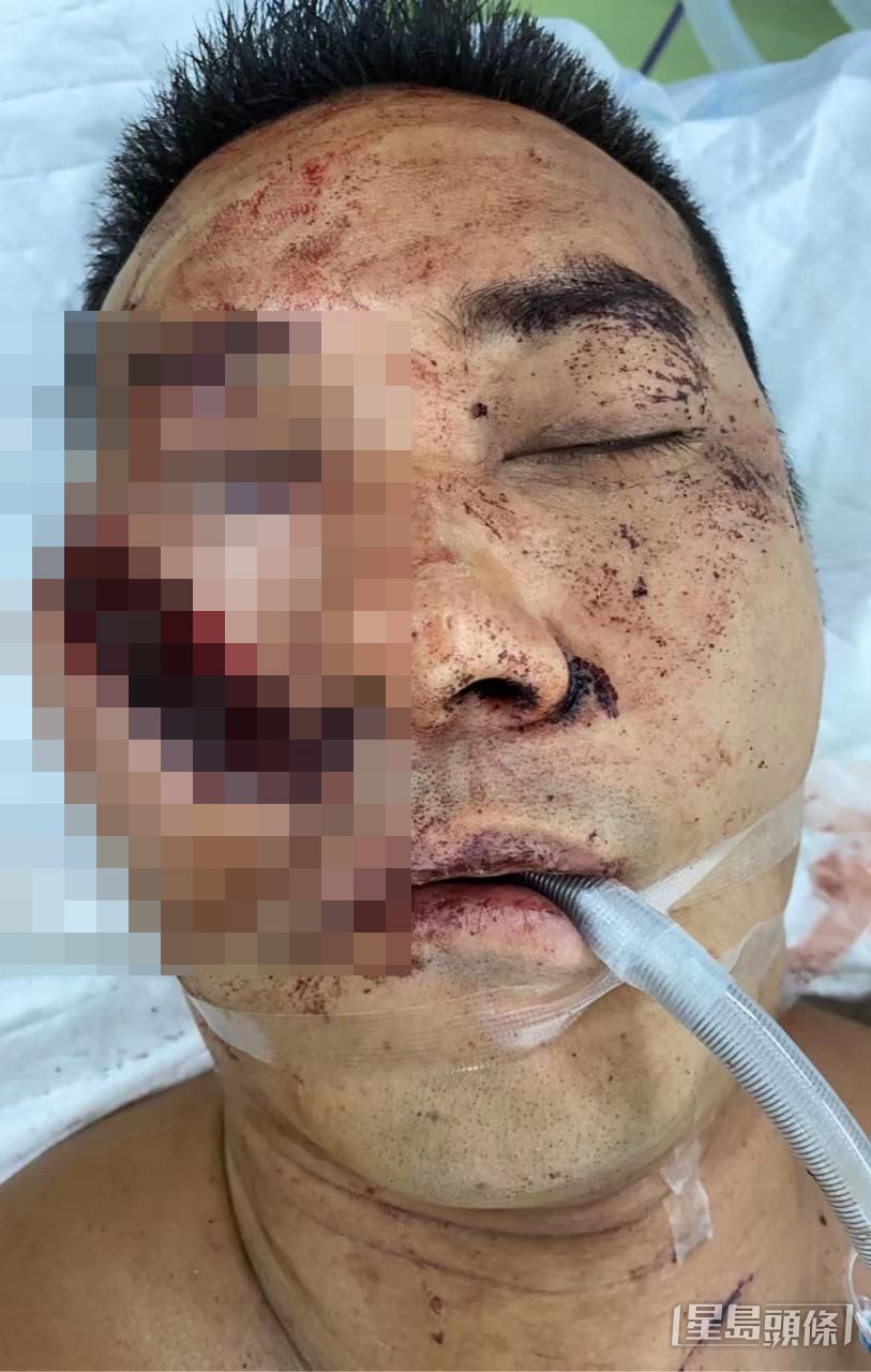 黃竣鋒臉上的傷口血肉模糊。