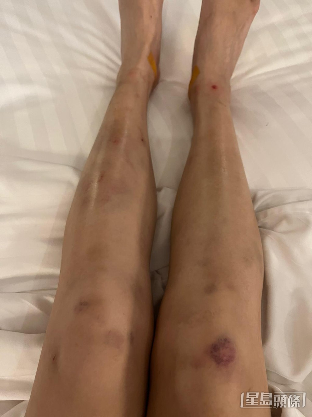Karen虽然搞到周身伤，但觉得这个经历好值得。