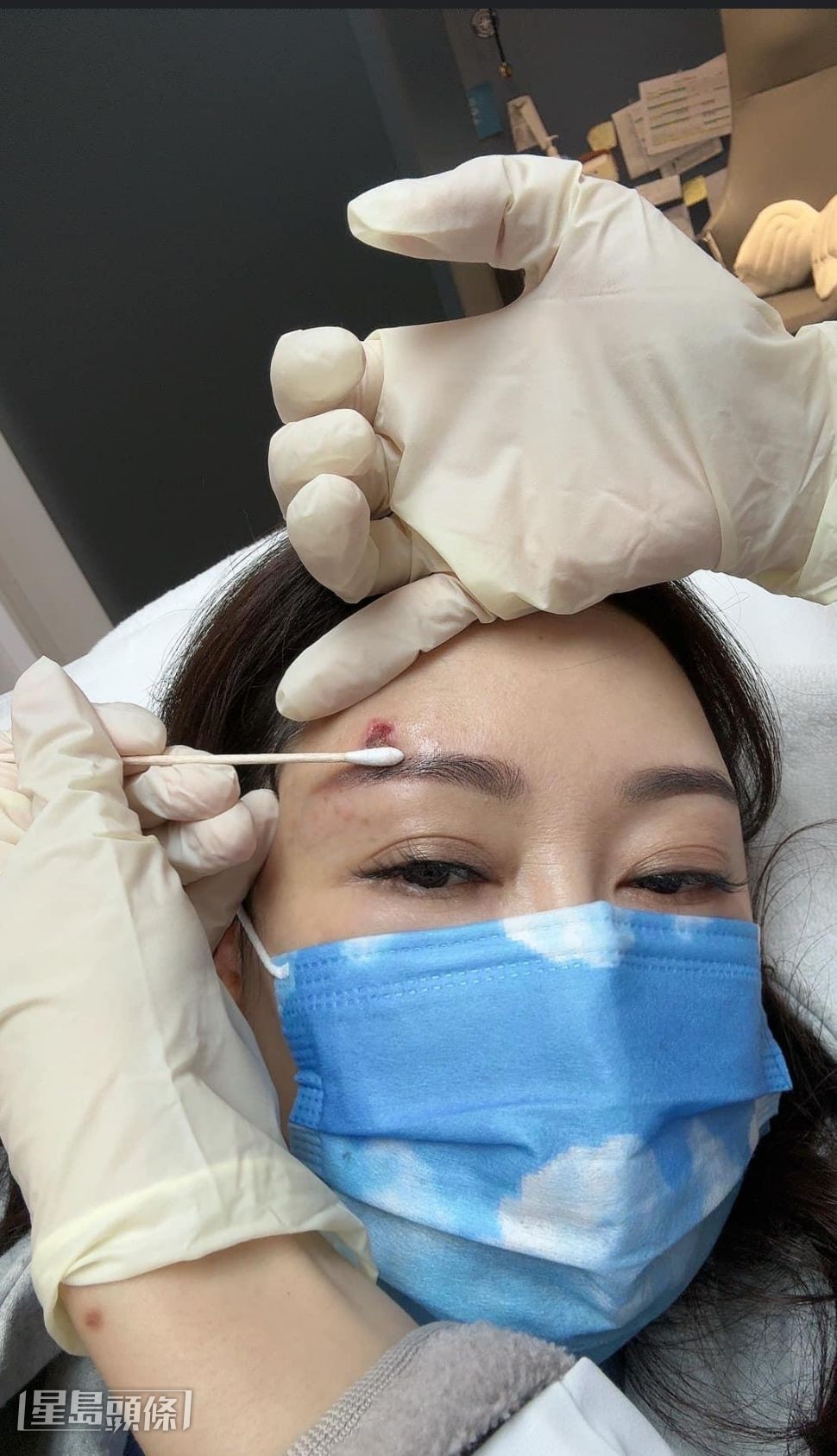 眉毛亦因「生蛇」缺了一部分。 眉毛亦因「生蛇」缺了一部分。