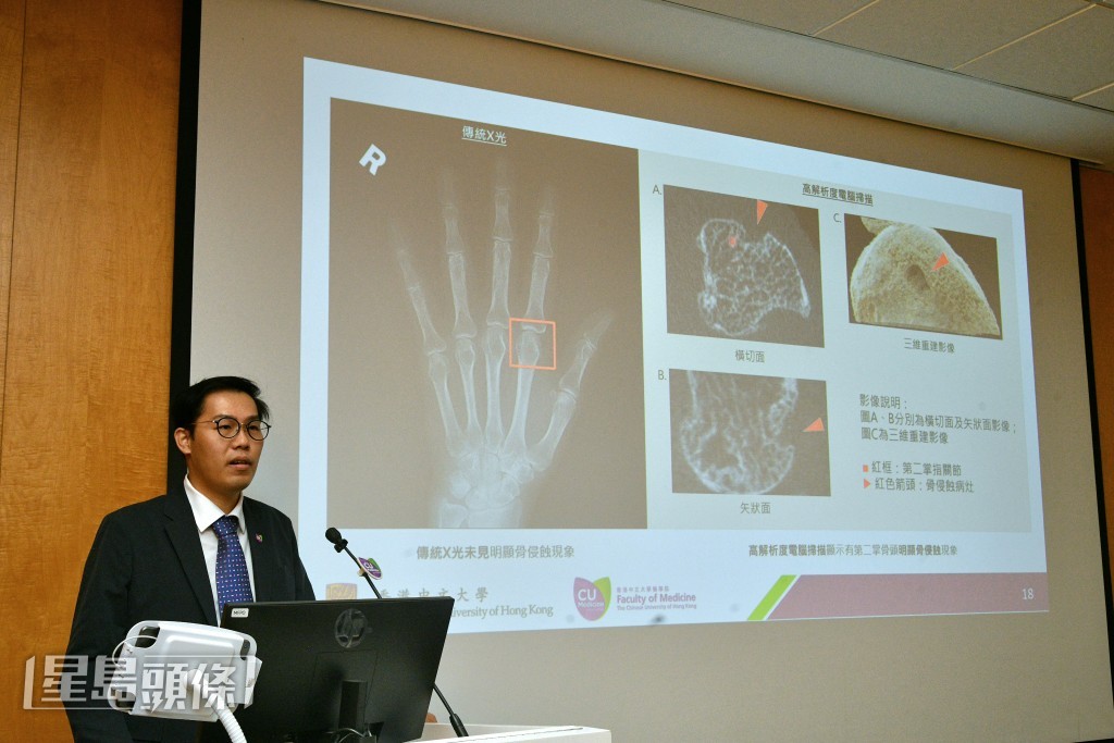 本港目前約有三萬人患有類風濕關節炎,骨侵蝕是該病的標誌性特徵。 本港目前約有三萬人患有類風濕關節炎,骨侵蝕是該病的標誌性特徵。