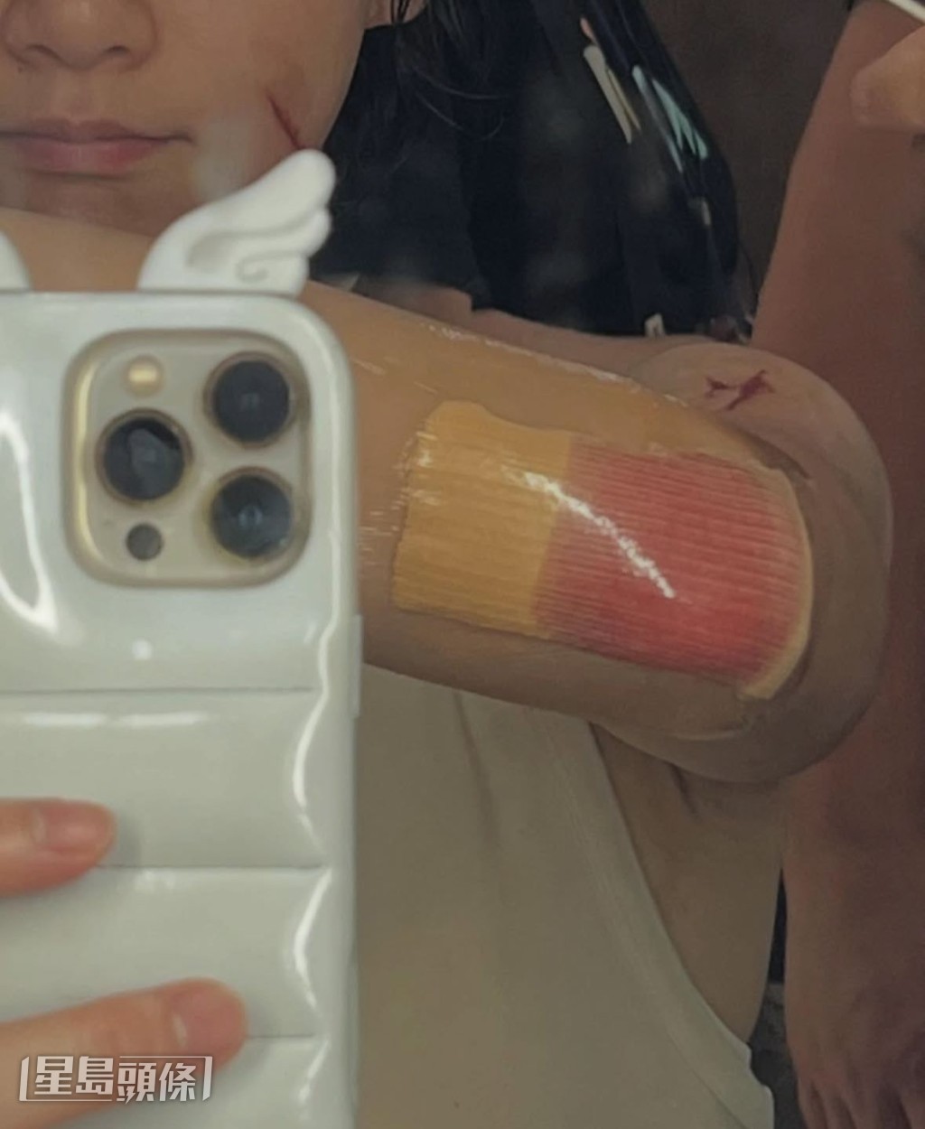 袁澧林剛在網上貼出拍戲時右手受傷的相片。