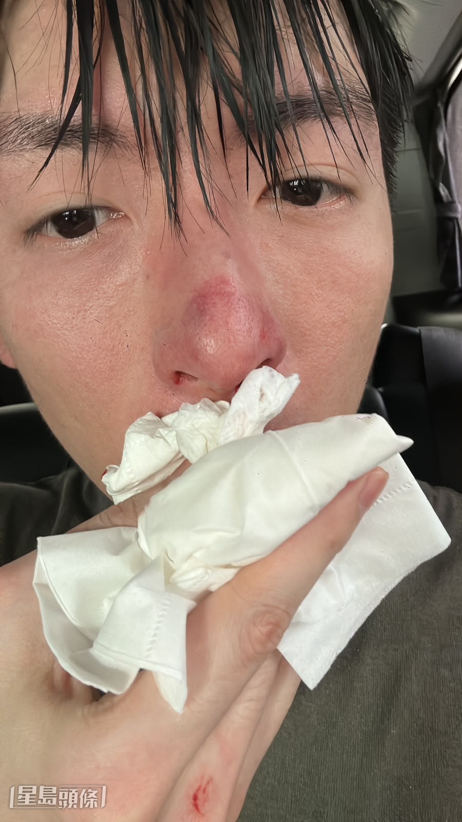 當時被對手重拳擊中鼻。(獨家圖片) 當時被對手重拳擊中鼻。(獨家圖片)