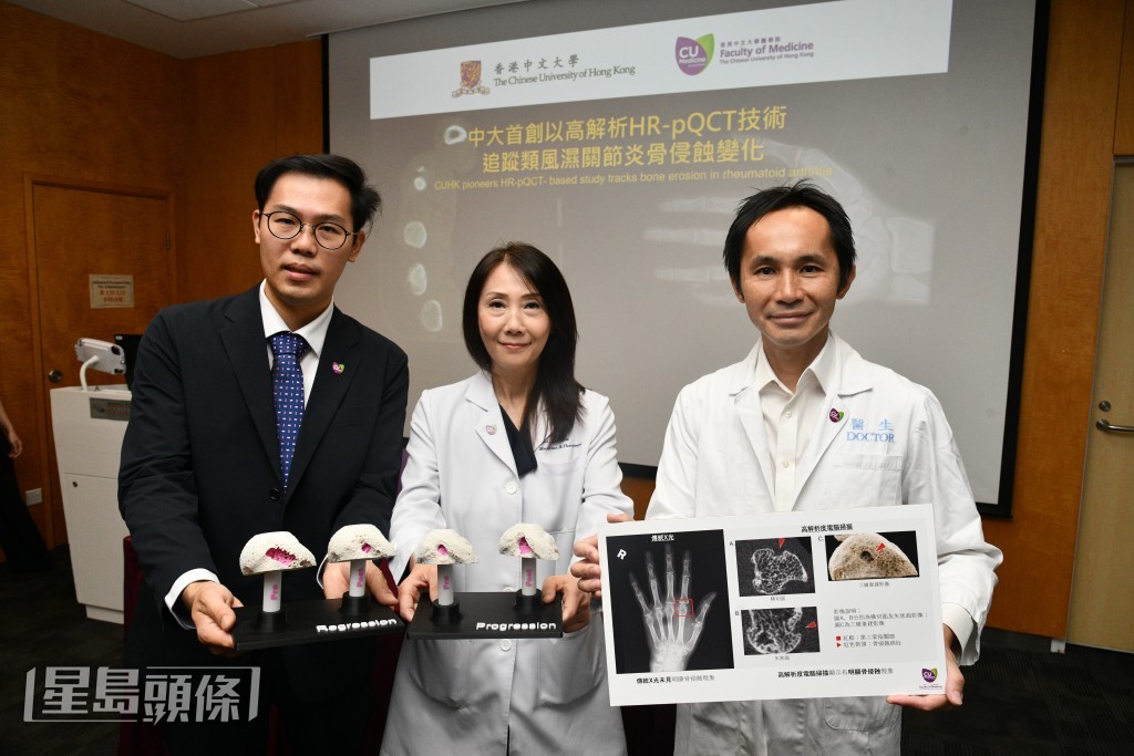 中大醫學院首創利用高解析度電腦斷層掃描技術「HR-pQCT」,透過三維影像分析類風濕關節炎骨侵蝕變化。 中大醫學院首創利用高解析度電腦斷層掃描技術「HR-pQCT」,透過三維影像分析類風濕關節炎骨侵蝕變化。