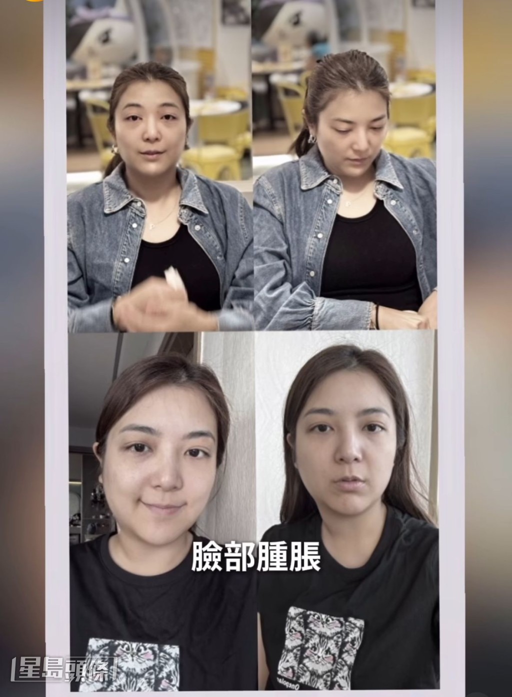 單文柔指自己無端眼腫、面腫和頸腫,病發照片變得面目全非。 單文柔指自己無端眼腫、面腫和頸腫,病發照片變得面目全非。