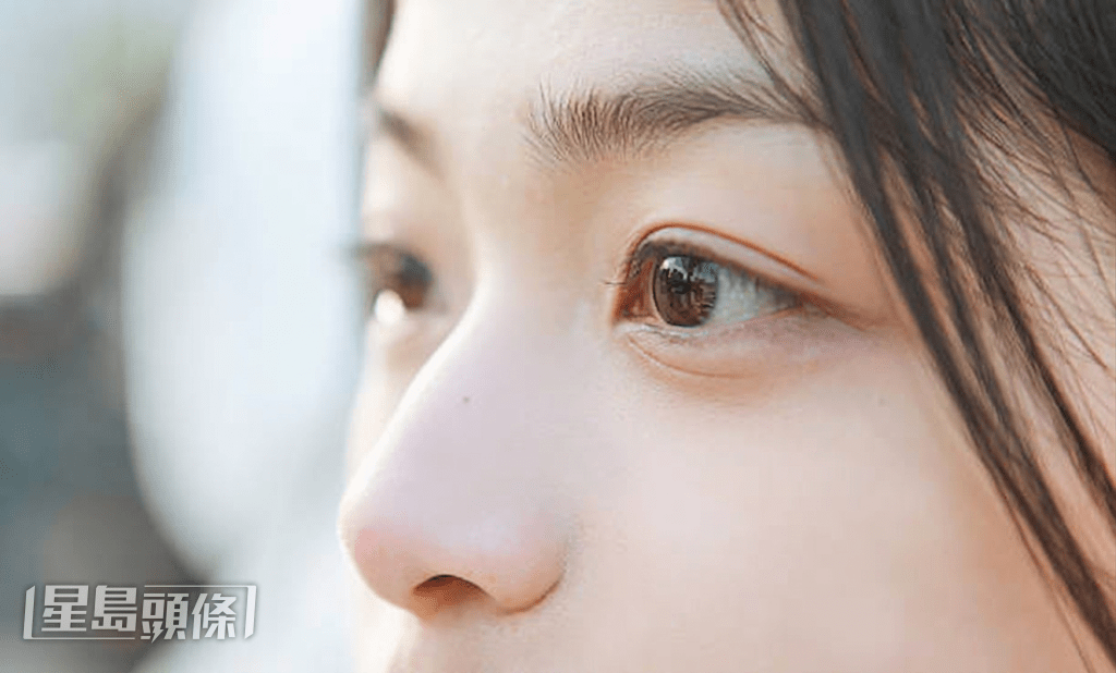 下眼睑下方如果有明显的皮肤折痕,这条线在医学上称为「丹尼摩根线」(Dennie-Morgan lines)。 下眼睑下方如果有明显的皮肤折痕,这条线在医学上称为「丹尼摩根线」(Dennie-Morgan lines)。