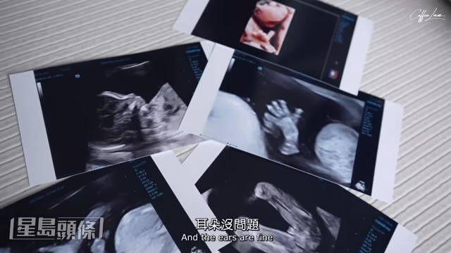 結果是BB的腦、血管流及眼鼻耳身體結構都沒問題，很多器官也正常。