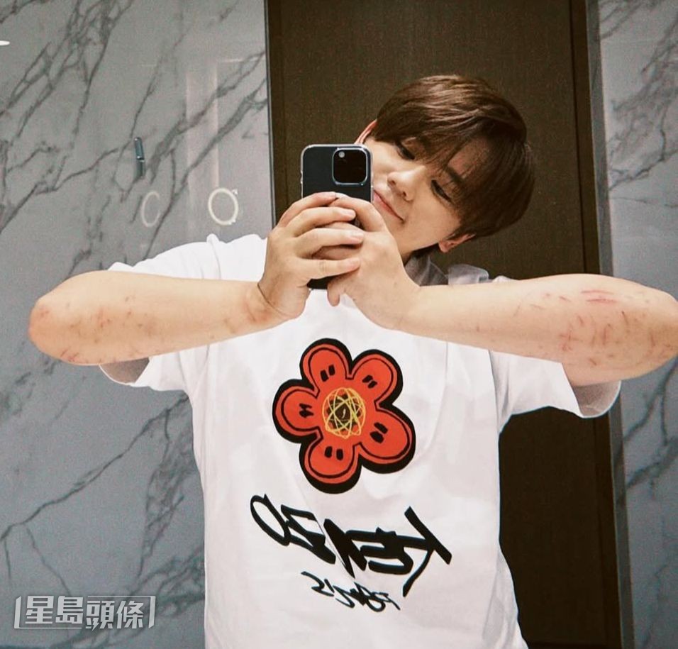 姜濤早前意外墮海,他自拍傷痕累累的手臂。 姜濤早前意外墮海,他自拍傷痕累累的手臂。