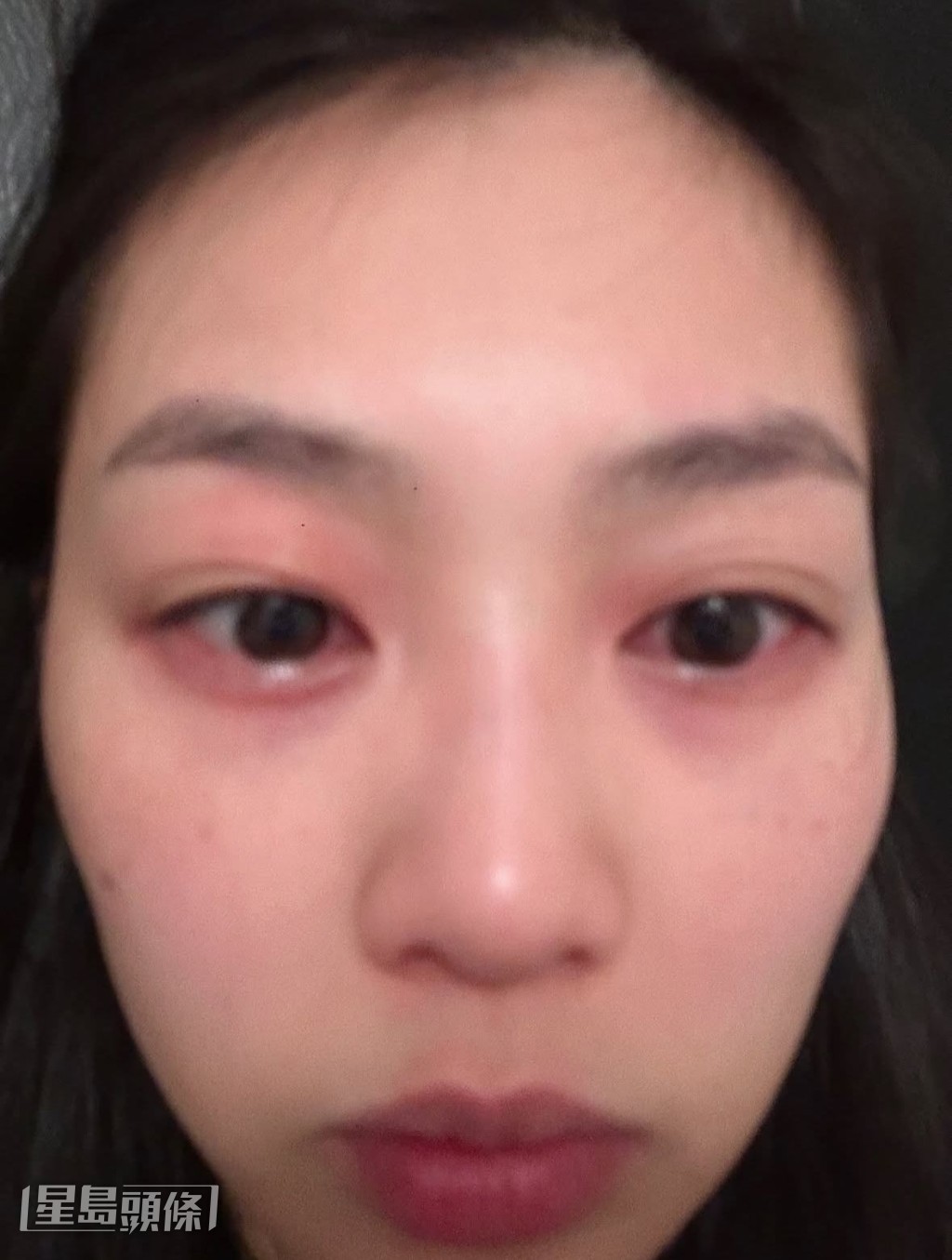 除了面腫、眼紅又流眼水,郭柏妍說當日甚至氣管收縮抖不到氣。 除了面腫、眼紅又流眼水,郭柏妍說當日甚至氣管收縮抖不到氣。