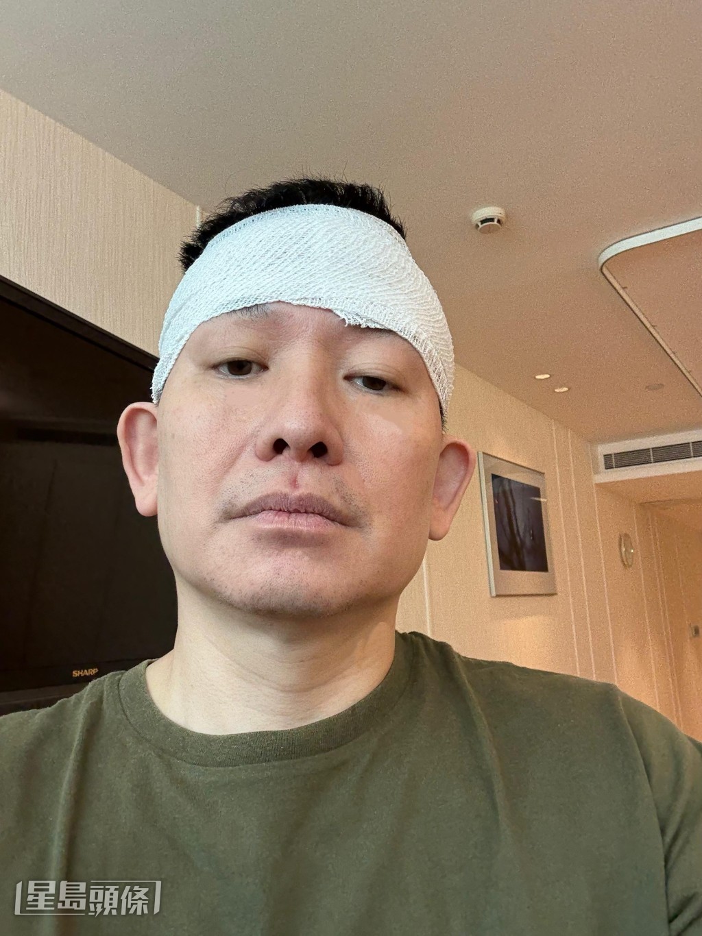 向展鵬自嘲頭部包紮後猶如「摩羅差」。