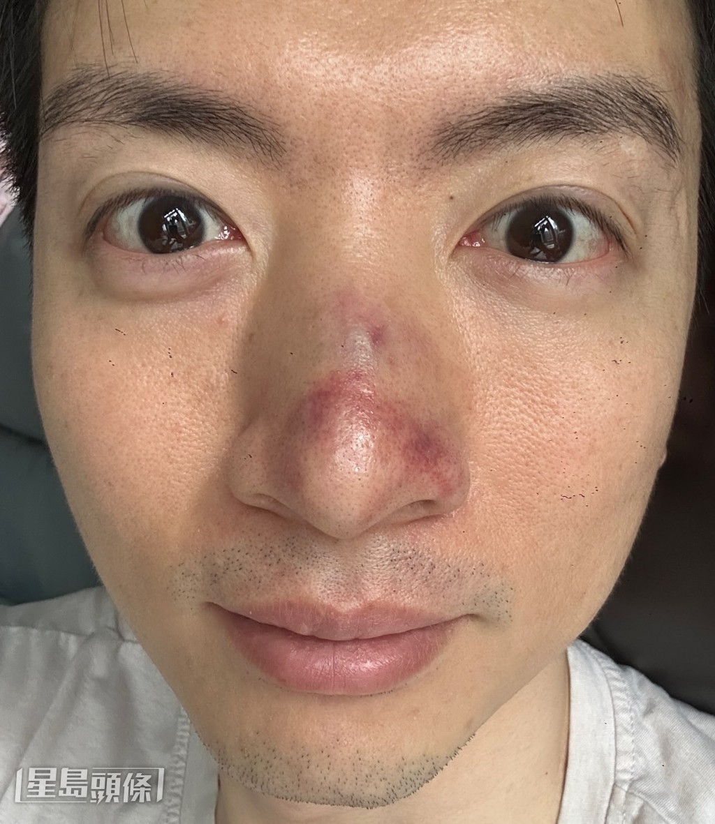 立即送院檢查,證實鼻骨骨折。(獨家圖片) 立即送院檢查,證實鼻骨骨折。(獨家圖片)