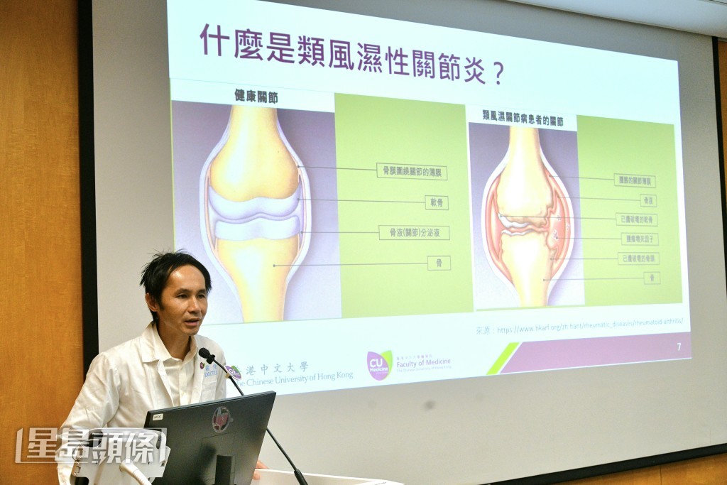 中大醫學院內科及藥物治療學系風濕科臨床副教授蘇晧指出,這項技術能精準計算出骨侵蝕範圍大小及分布。 中大醫學院內科及藥物治療學系風濕科臨床副教授蘇晧指出,這項技術能精準計算出骨侵蝕範圍大小及分布。