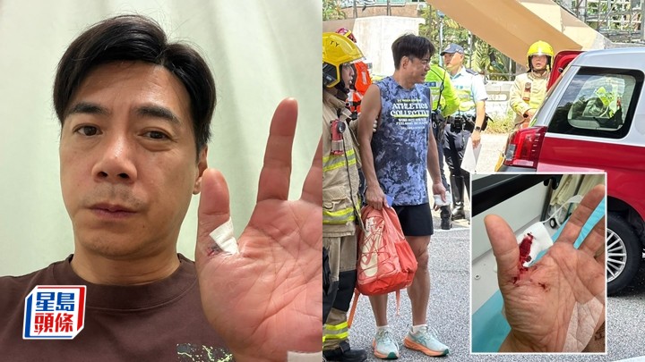 獨家丨「接龍Andy」崔錦棠車禍出院後首露面 面青青親述恐怖經過：以為會死仲消化緊 虎口割得太開恐有後遺症。