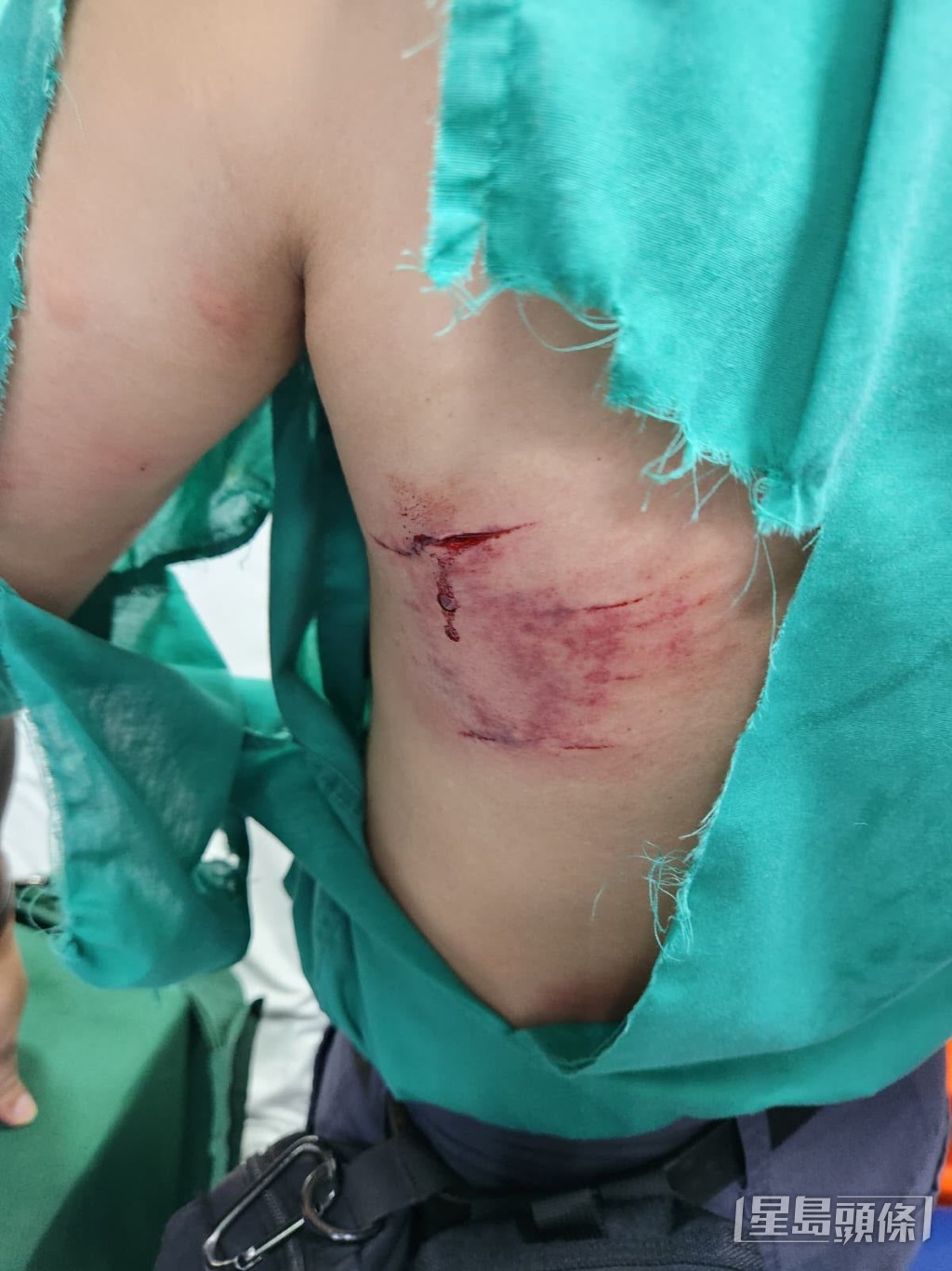 9月11日,一名郵差在米埔派信時突遭狗隻從後撲上,腰部及左腳被咬傷送院。(張偉權提供) 9月11日,一名郵差在米埔派信時突遭狗隻從後撲上,腰部及左腳被咬傷送院。(張偉權提供)