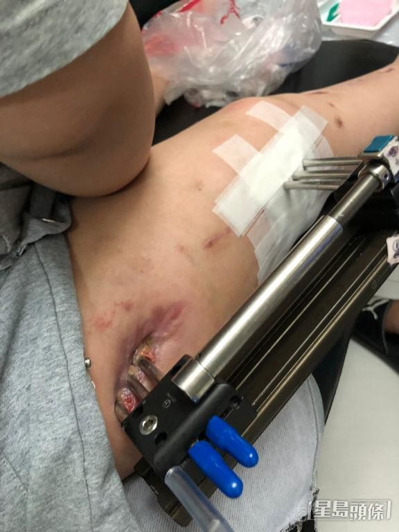 有患者憶述每日清洗傷口的過程苦不堪言。 受訪者提供