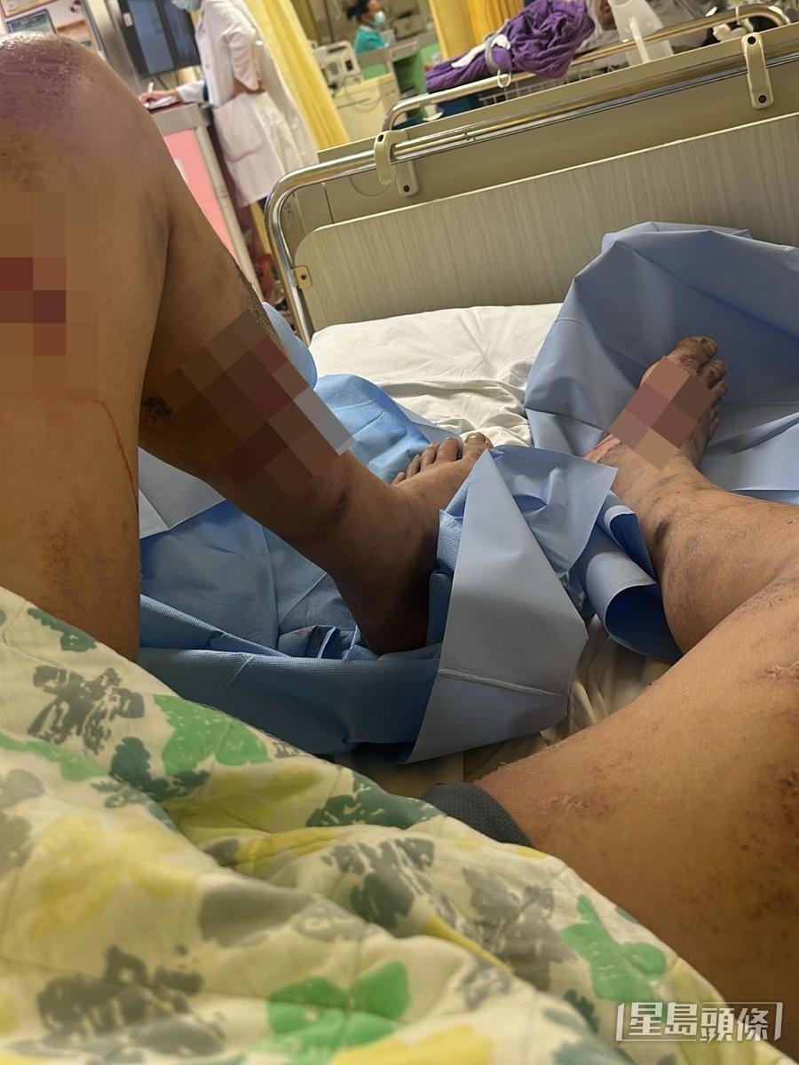 去年文禮「落石屎」期間,被灼熱混凝土灼傷腿部,但最後被迫隱瞞。受訪者提供 去年文禮「落石屎」期間,被灼熱混凝土灼傷腿部,但最後被迫隱瞞。受訪者提供