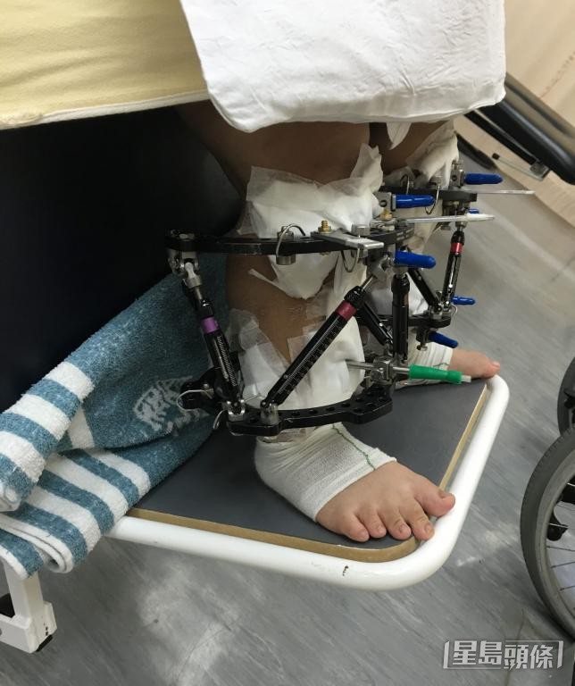 有患者接受骨骼延長手術，須於小腿鑲上螺絲固定。 受訪者提供