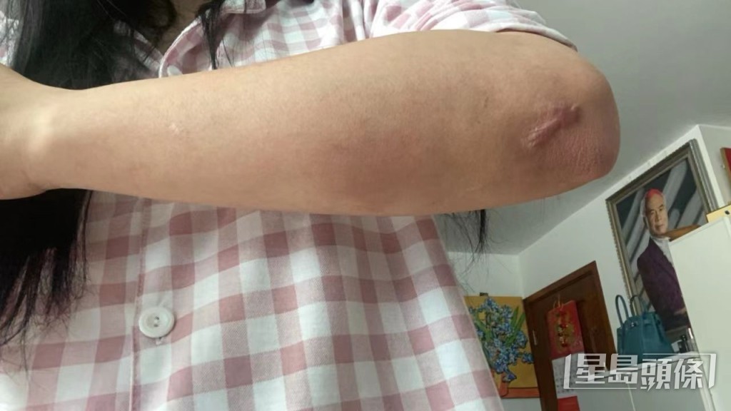 手肘留有疤痕。