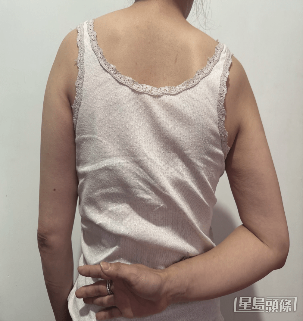 51岁的陈女士患上「五十肩」治疗前手臂不能举高,无法自行「扣Bra扣」。(患者及周惠珊医师提供) 51岁的陈女士患上「五十肩」治疗前手臂不能举高,无法自行「扣Bra扣」。(患者及周惠珊医师提供)