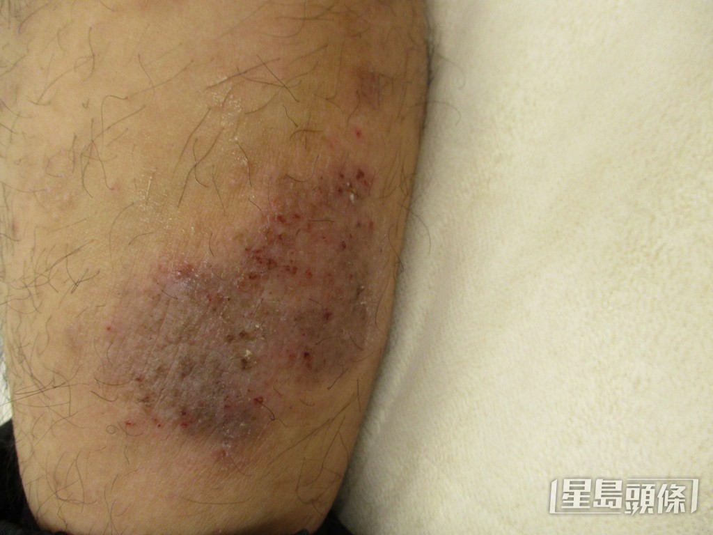 当湿疹病人反复搔抓患处，便可有机会引发更严重的问题，例如神经性皮炎，导致皮肤局部增厚。（陈涌医生提供）