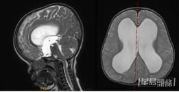 部分病童會出現腦積水。 受訪者提供