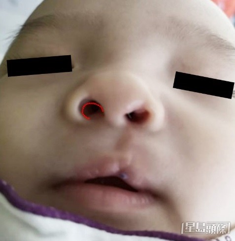 家長指男嬰於兒童醫院補唇後,右鼻孔較左鼻孔大(紅線顯示左鼻孔大小)。 家長指男嬰於兒童醫院補唇後,右鼻孔較左鼻孔大(紅線顯示左鼻孔大小)。