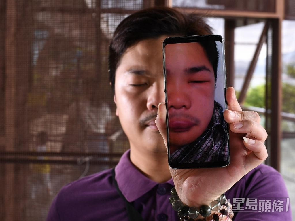 冼庭峯發病時,經歷臉腫之苦,猶如換臉。 冼庭峯發病時,經歷臉腫之苦,猶如換臉。