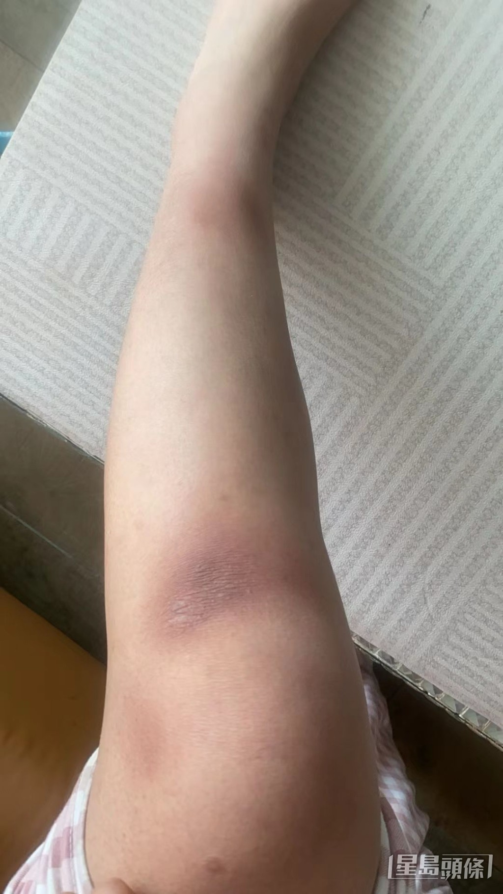 手腳都有瘀傷。