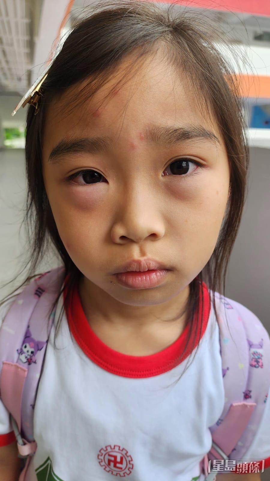 女兒晴晴發病時,眼瞼及嘴唇腫脹。 受訪者提供 女兒晴晴發病時,眼瞼及嘴唇腫脹。 受訪者提供