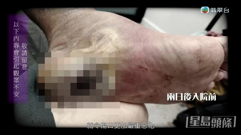 八両菜腳部潰爛,傷口發黑深到見骨。 八両菜腳部潰爛,傷口發黑深到見骨。