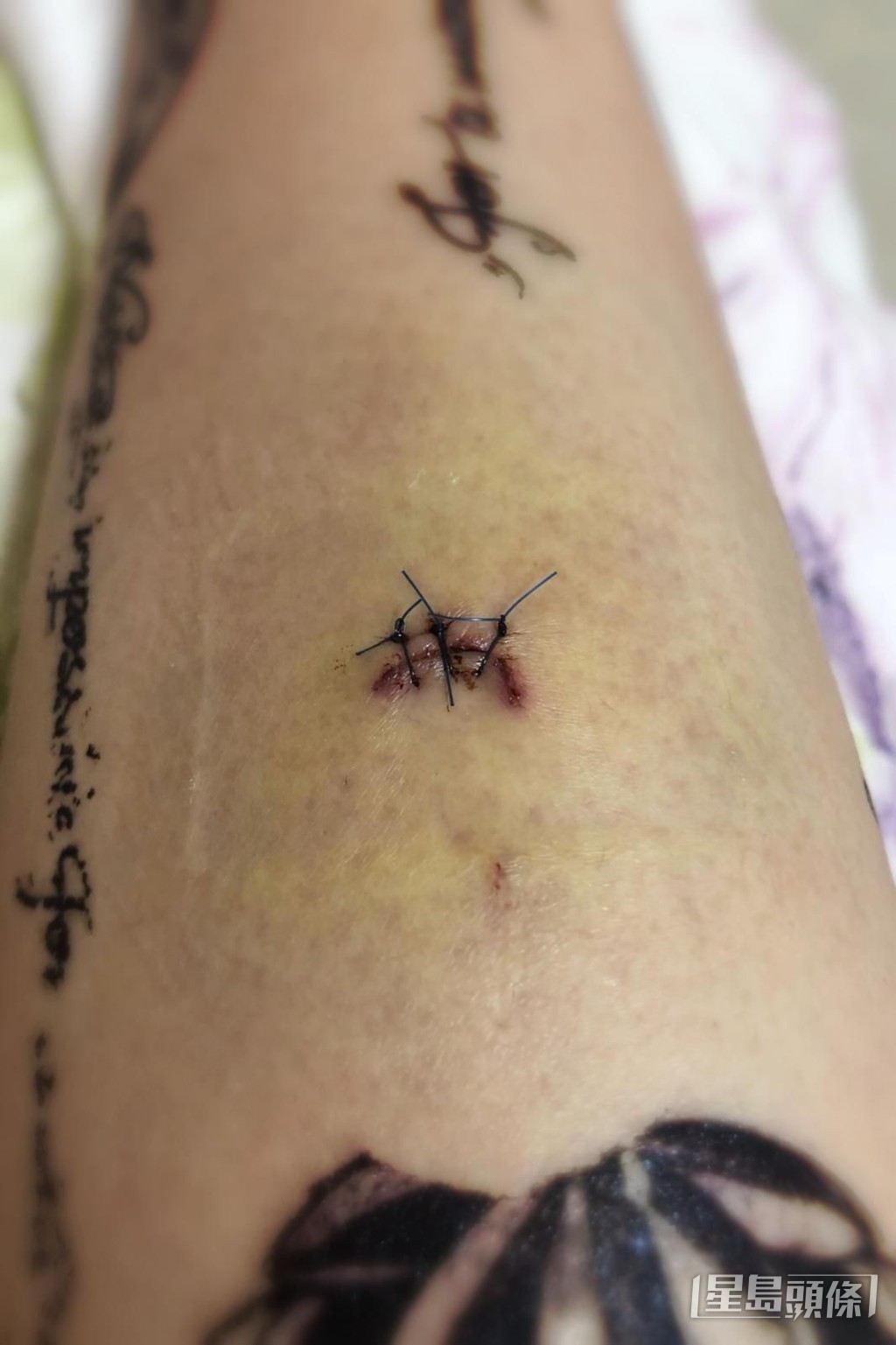 打到受傷縫針。