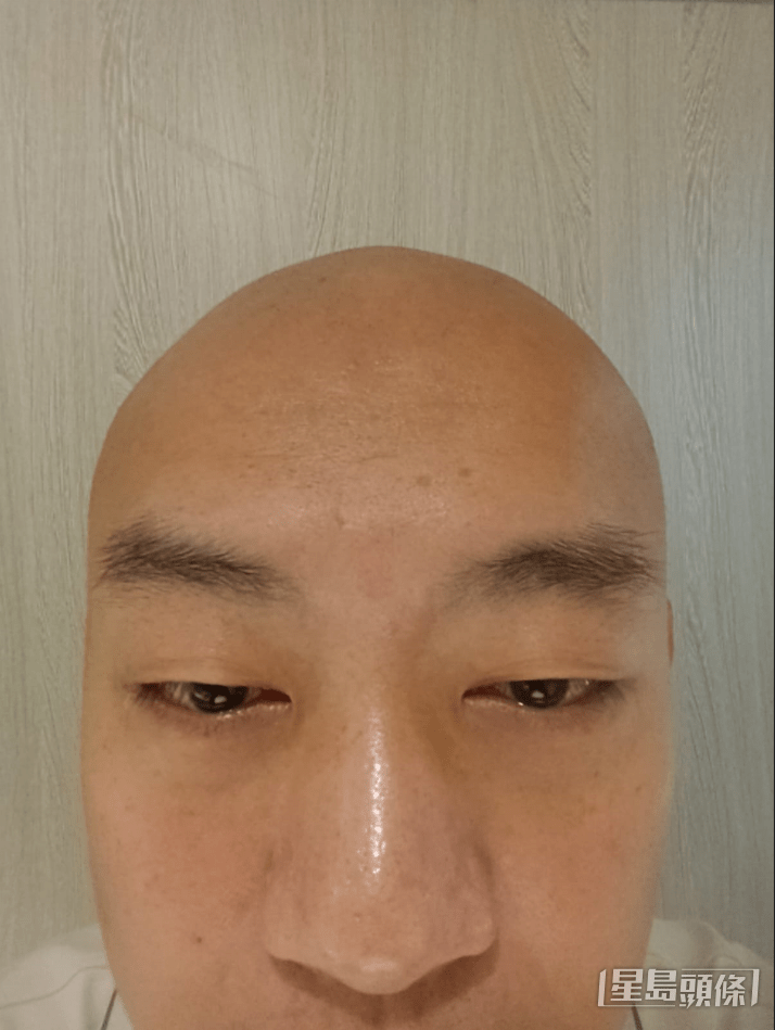 李嘉患上过敏性结膜炎。