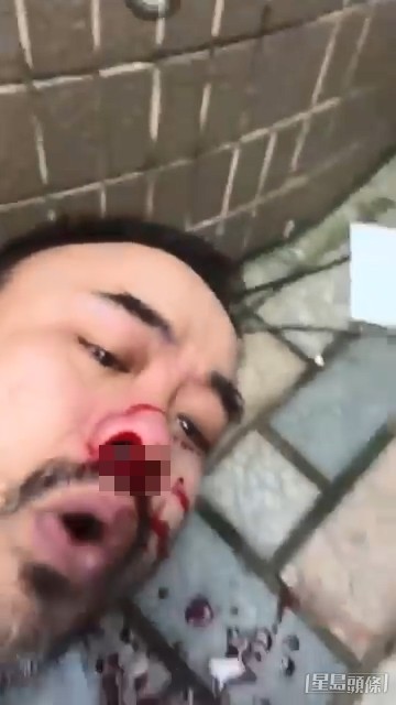 邵子風倒地後面及鼻部血如泉湧。