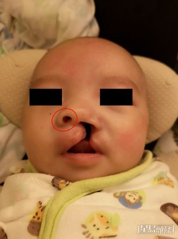 男嬰出生時出現兔唇。 男嬰出生時出現兔唇。