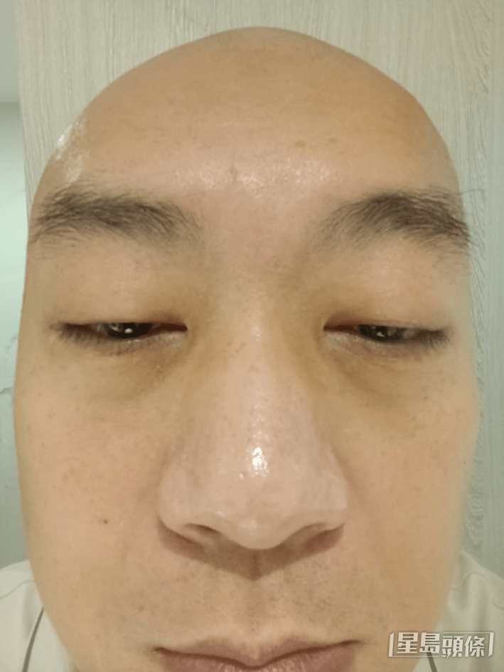李嘉透露，两个多月前眼睛出现血丝、红筋及有异物感。