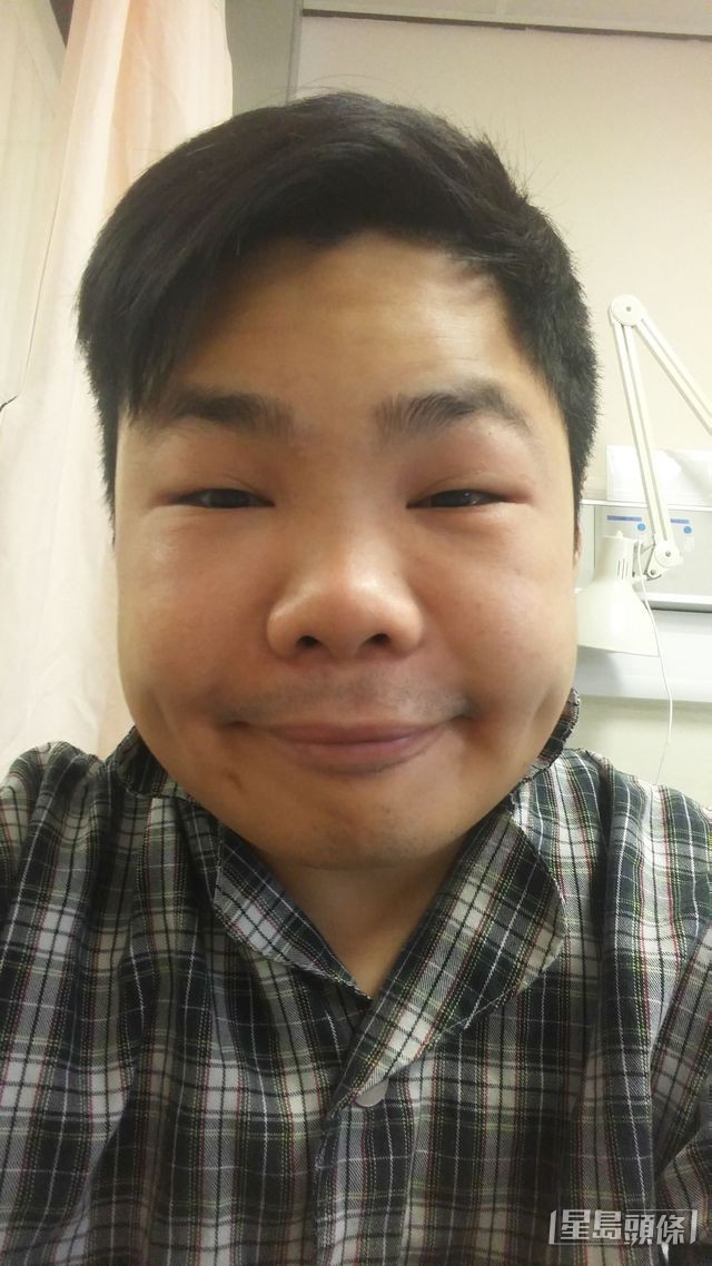 冼庭峯曾多次臉部發病,嘴唇及眼瞼嚴重腫脹,容貌判若兩人。 受訪者提供 冼庭峯曾多次臉部發病,嘴唇及眼瞼嚴重腫脹,容貌判若兩人。 受訪者提供