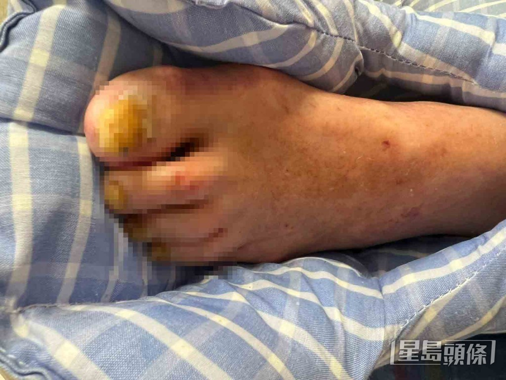 方俊日前從外地回港後往護老院探望張偉文,驚見張偉文的雙腳紅腫、瘀黑、皮膚潰爛。。 方俊日前從外地回港後往護老院探望張偉文,驚見張偉文的雙腳紅腫、瘀黑、皮膚潰爛。。