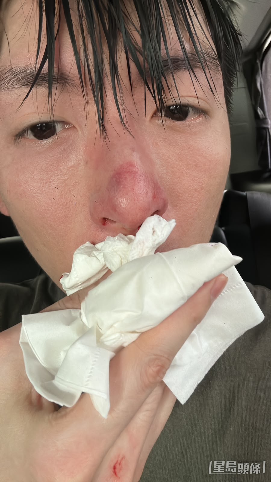 譚坤倫當時被對手重拳擊中鼻。(獨家圖片)。 譚坤倫當時被對手重拳擊中鼻。(獨家圖片)。