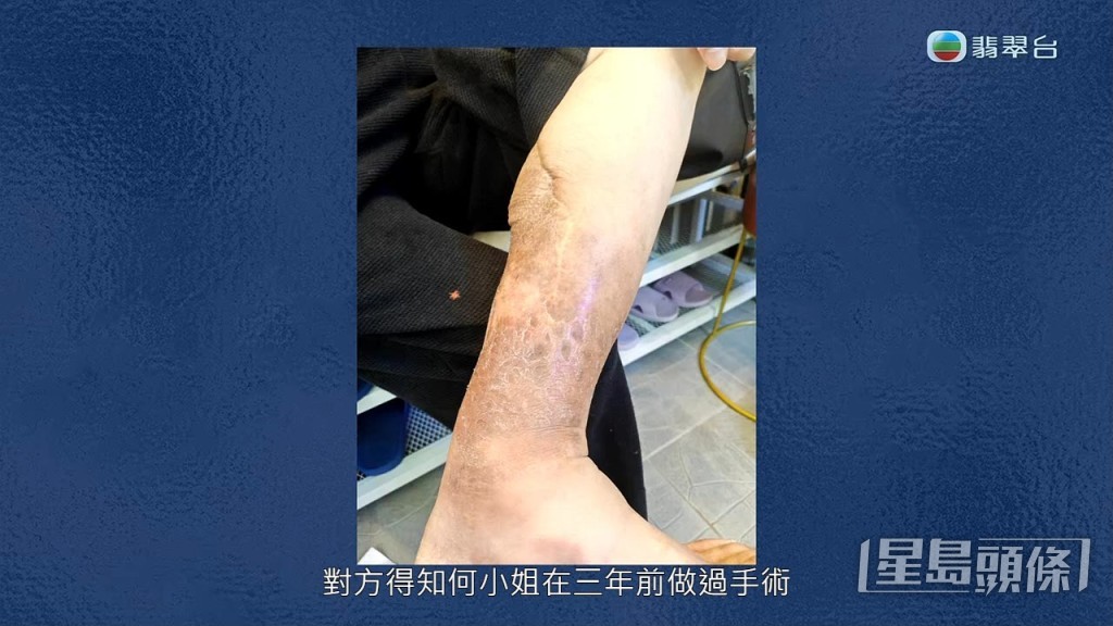 有糖尿病的八両金年前治好腳患。 有糖尿病的八両金年前治好腳患。