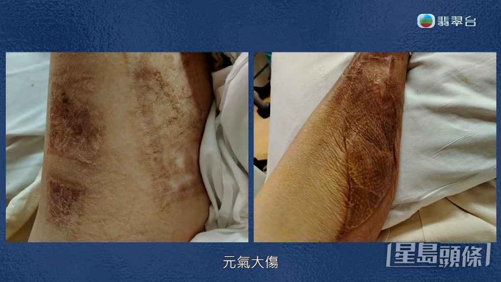 年前做完腳患手術後元氣大傷。 年前做完腳患手術後元氣大傷。