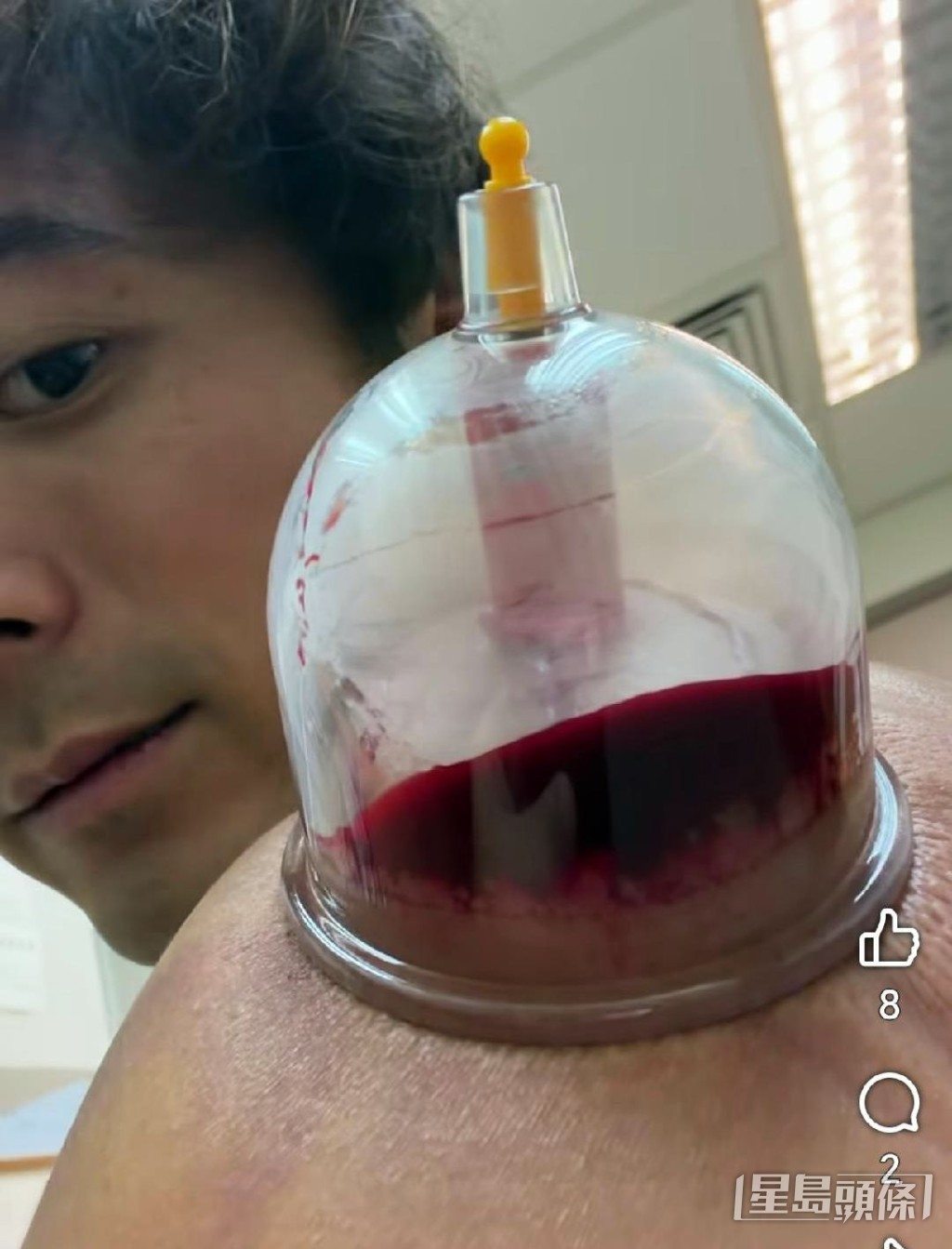 Alex貼出一些治療肩周炎時的抽血相片後，竟然有很多人詢問是在哪裏治療？